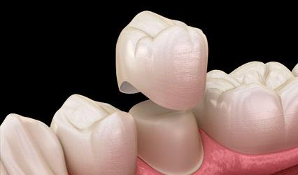 Dental Crowns