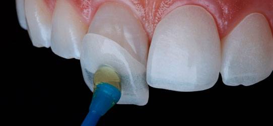 Dental Veneers image