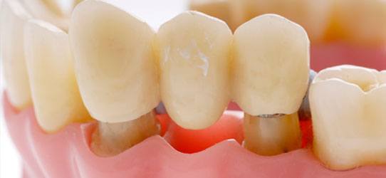 Dental Bridge image