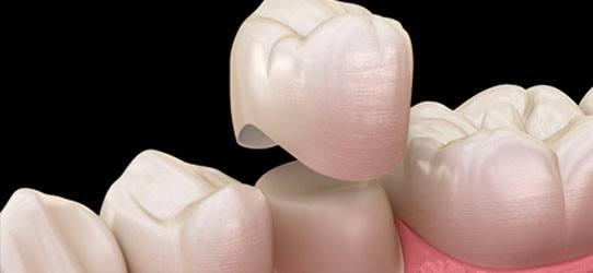 Dental Crowns image