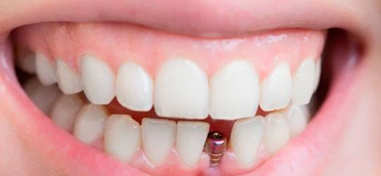 Dental Implants image